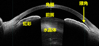 白内障手術前