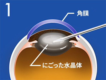 白内障手術のおおまかな流れ1