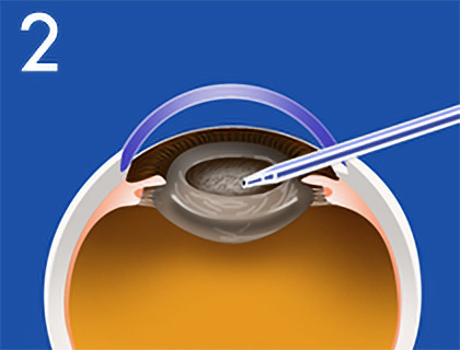 白内障手術のおおまかな流れ2