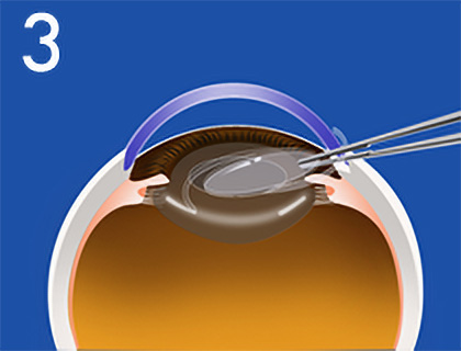 白内障手術のおおまかな流れ3
