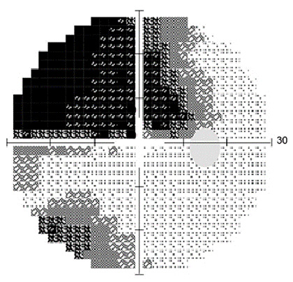 緑内障の視野検査結果