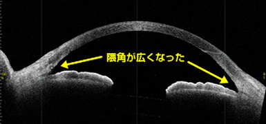 白内障手術後