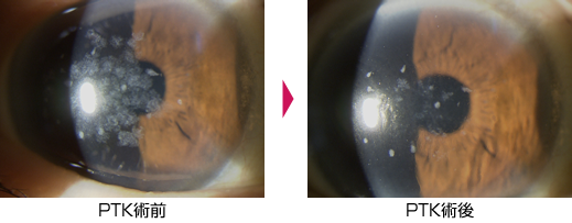 PTK術前・術後
