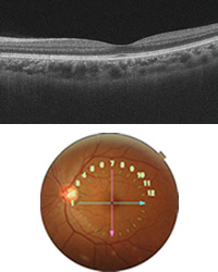 光干渉断層計(OCT:Optical Coherence Tomography)