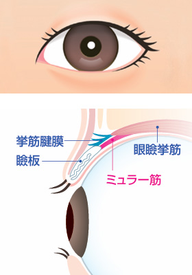 アップニーク-眼瞼下垂ではない目