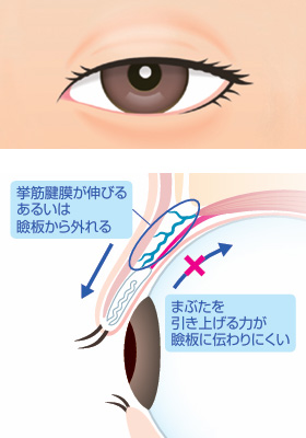 アップニーク眼瞼下垂の目