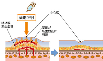 硝子体注射